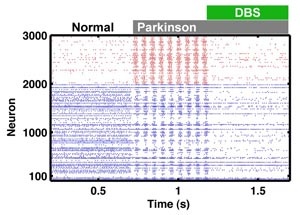 Crippling rhythms of the brain 