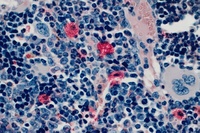 Fighting Resistant Blood Cancer Cells 