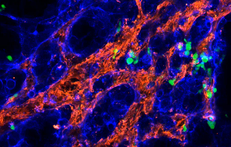 Gamma-Delta-T-Zellen können aggressiven Brustkrebs bekämpfen